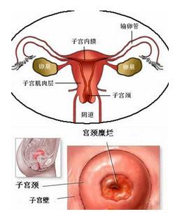 女性患宫颈息肉之后会出现哪些症状表现？